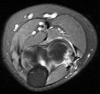 Figure 4 for case Tear of combined origin of the lateral ulnar collateral ligament and radial collateral of elbow (RID2043)(RID2035)